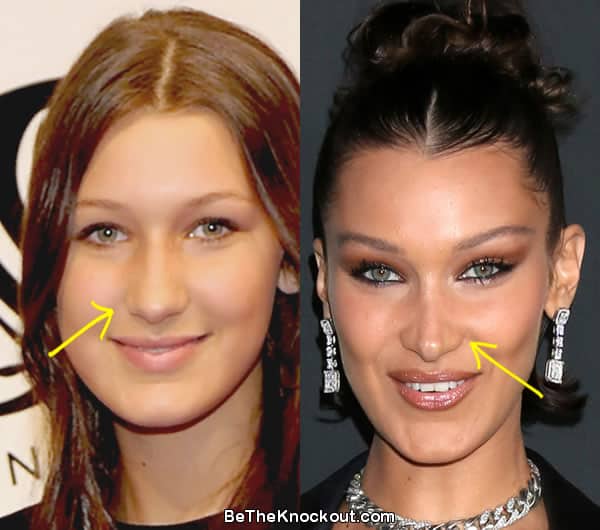 Bella Hadid nose job before and after comparison photos