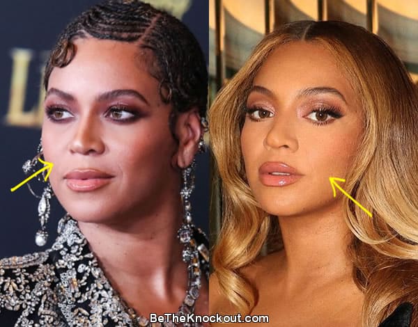 Beyonce botox before and after comparison photo