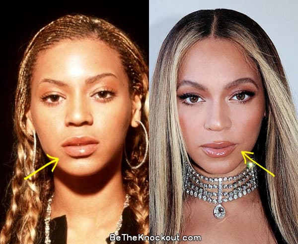 Beyonce lip fillers before and after comparison photo