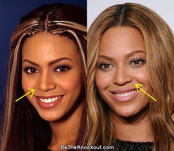 Beyonce nose job before and after comparison photo