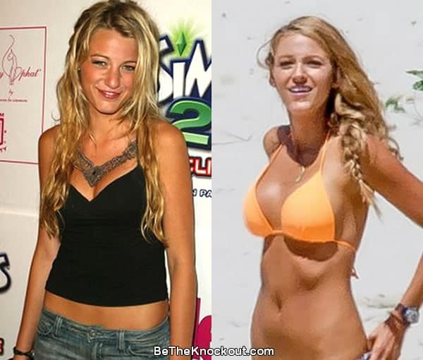 Blake Lively boob job before and after comparison photo