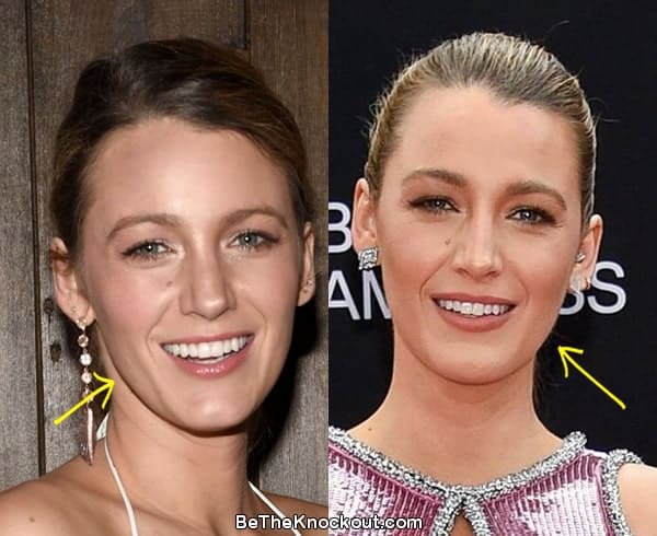 Blake Lively botox before and after comparison photo