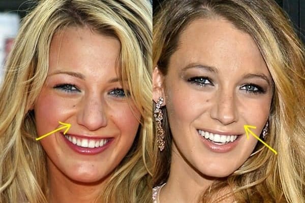 Blake Lively nose job before and after comparison photo