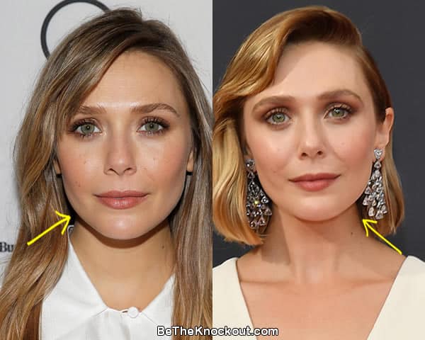 Elizabeth Olsen botox before and after comparison photo