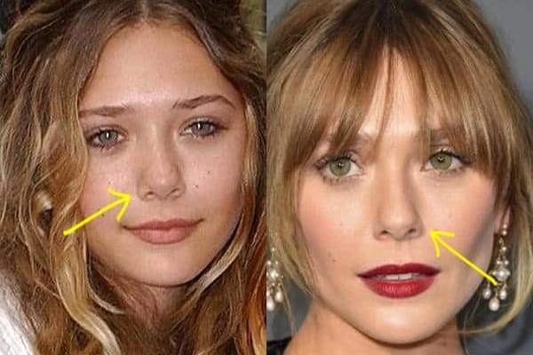 Elizabeth Olsen nose job before and after comparison photo