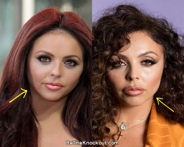 Jesy Nelson botox before and after comparison photo