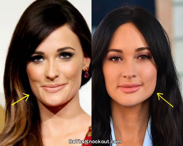 Kacey Musgraves botox before and after comparison photo