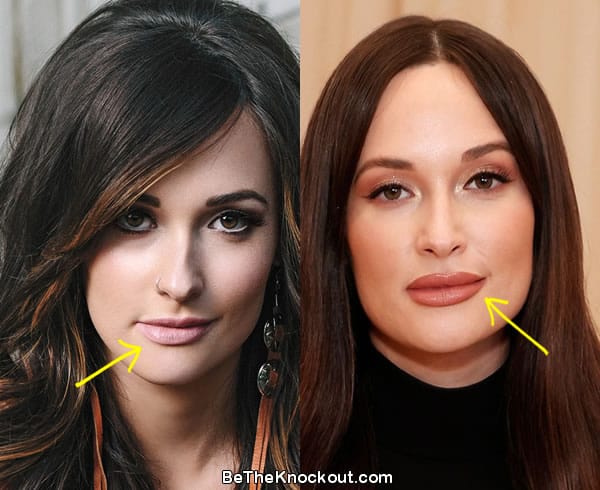 Kacey Musgraves lip fillers before and after comparison photo