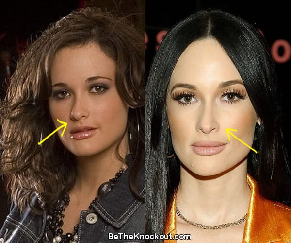 Kacey Musgraves nose job before and after comparison photo
