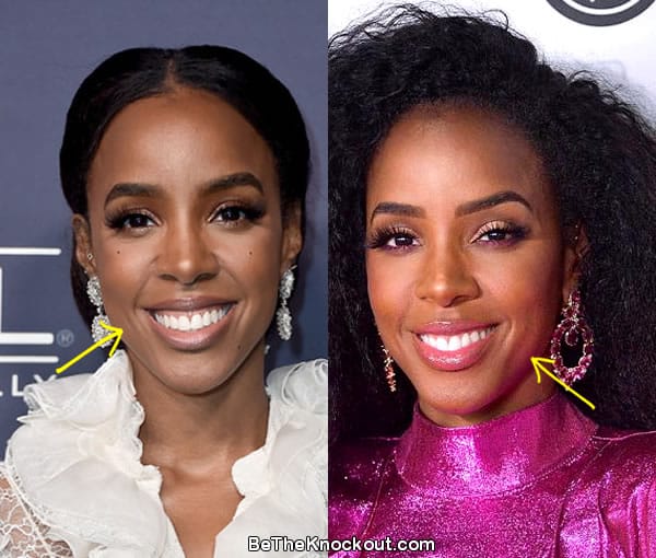 Kelly Rowland botox before and after comparison photo
