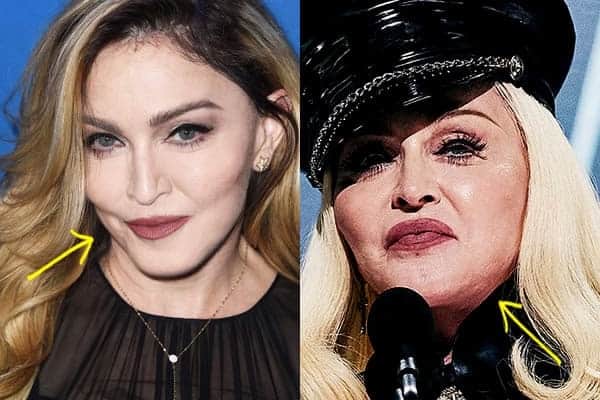 Madonna botox before and after comparison photo