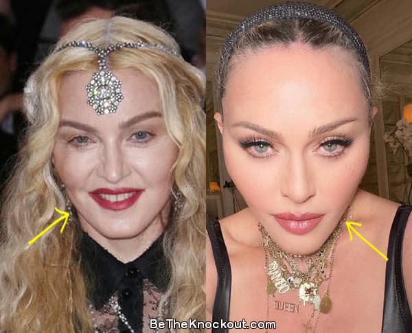 Madonna facelift before and after comparison photo