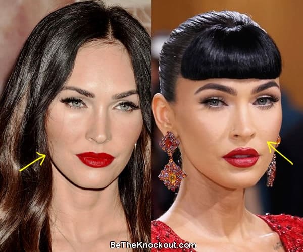 Megan Fox botox before and after comparison photo