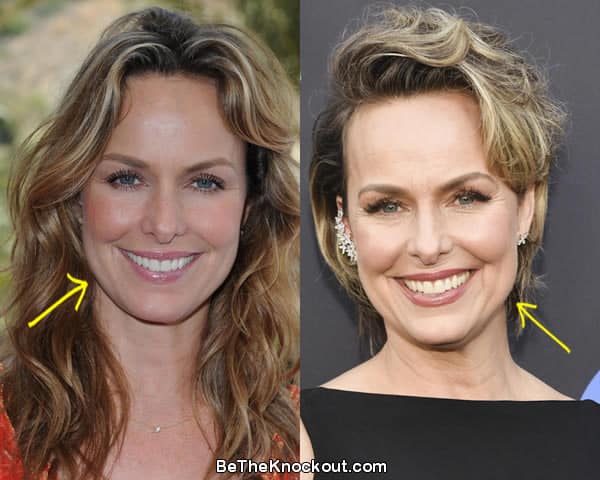 Melora Hardin botox before and after comparison photo