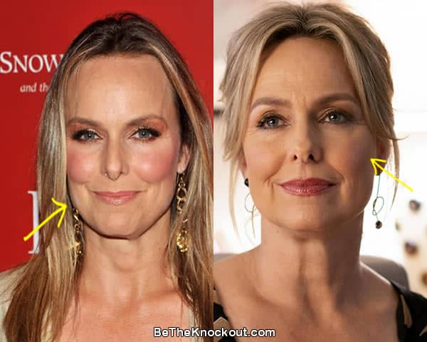 Melora Hardin facelift before and after comparison photo