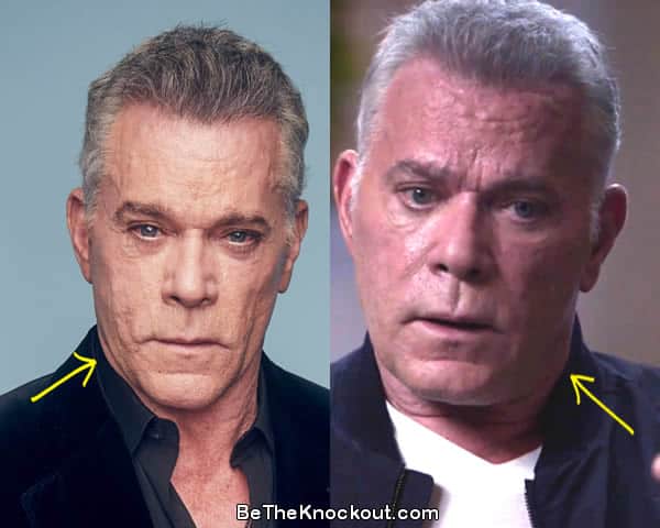 Ray Liotta botox before and after comparison photo