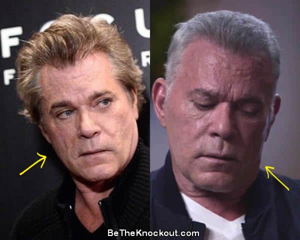 Ray Liotta facelift before and after comparison photo