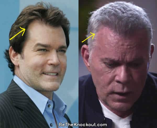 Ray Liotta hair transplant before and after comparison photo