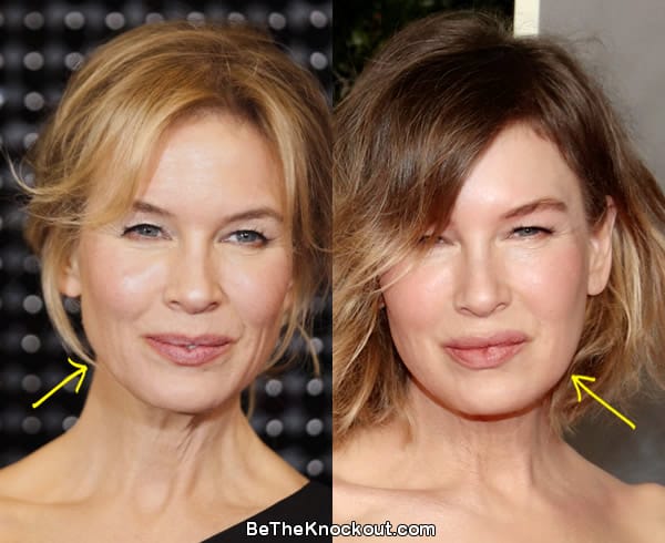 Renee Zellweger botox before and after comparison photo