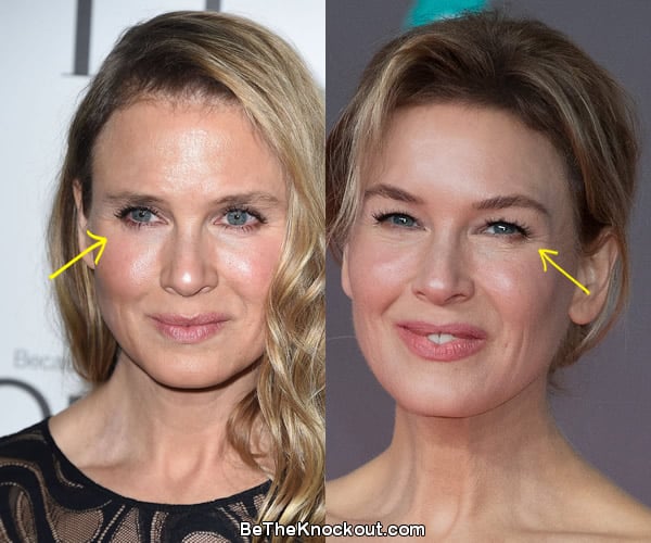 Renee Zellweger eye lift before and after comparison photo
