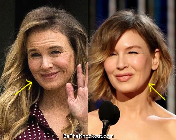 Renee Zellweger facelift before and after comparison photo