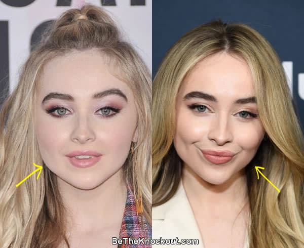 Sabrina Carpenter botox before and after comparison photo