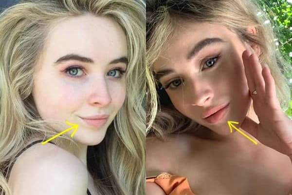 Sabrina Carpenter lip fillers before and after comparison photo