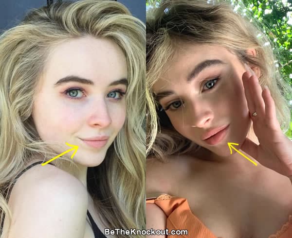 Sabrina Carpenter lip fillers before and after comparison photo