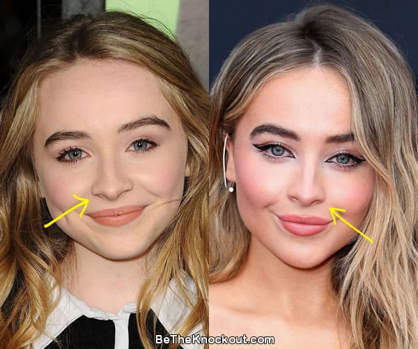 Sabrina Carpenter nose job before and after comparison photo