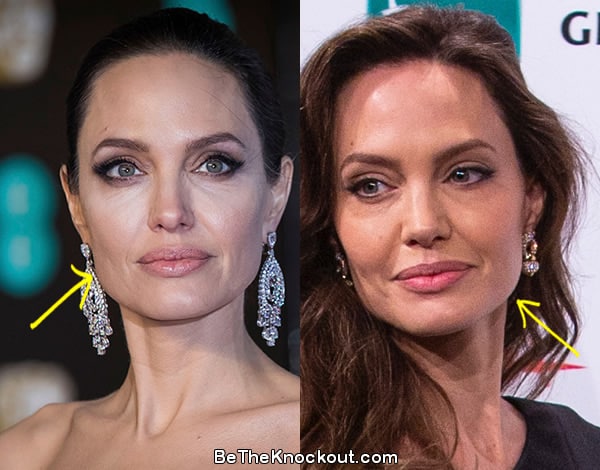 Angelina Jolie facelift before and after comparison photo