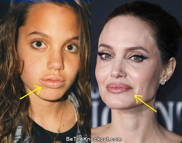 Angelina Jolie lip fillers before and after comparison photo
