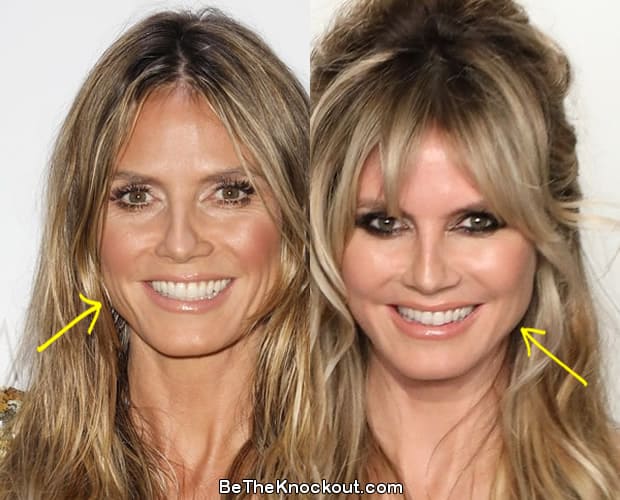 Heidi Klum botox before and after comparison photo