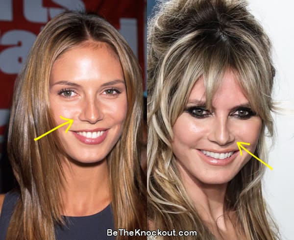 Heidi Klum nose job before and after comparison photo