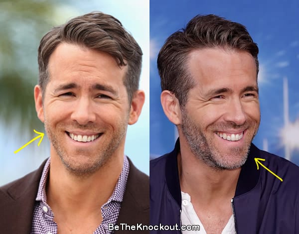 Ryan Reynolds botox before and after comparison photo