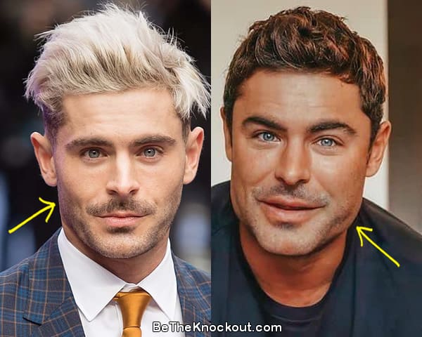 Zac Efron botox before and after comparison photo