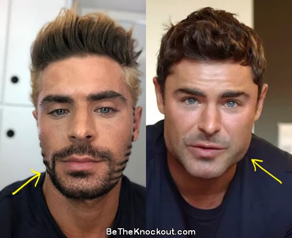 Zac Efron facelift before and after comparison photo