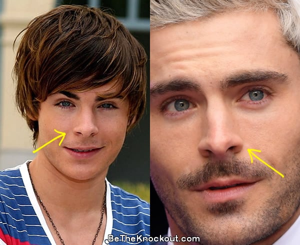 Zac Efron nose job before and after comparison photo
