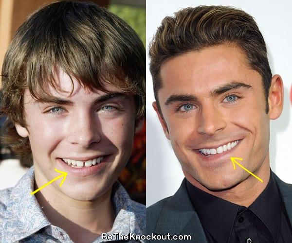 Zac Efron teeth before and after comparison photo