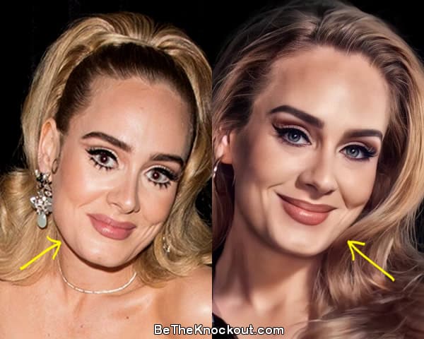 Adele botox before and after comparison photo