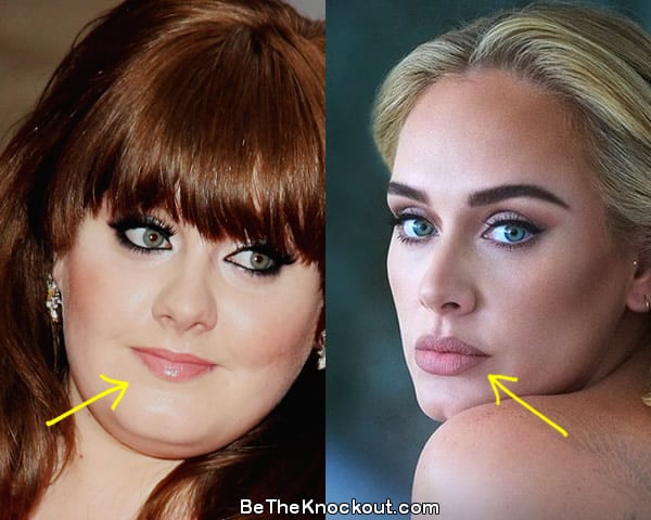 Adele lip fillers before and after comparison photo