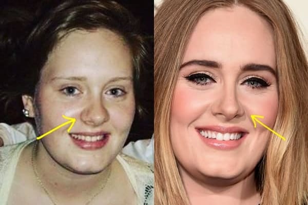 Adele nose job before and after comparison photo