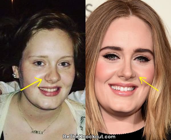 Adele nose job before and after comparison photo