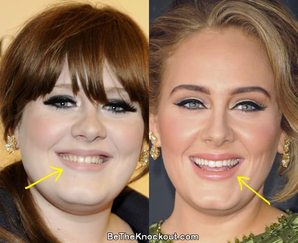 Adele teeth before and after comparison photo