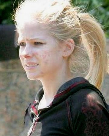 Avril Lavigne with pimple scars under the sun