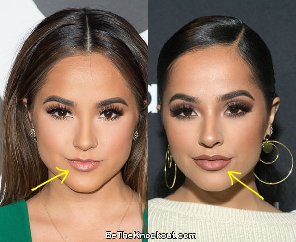 Becky G lip fillers before and after comparison photo