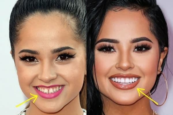 Becky G teeth before and after comparison photo