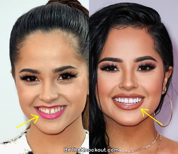 Becky G teeth before and after comparison photo