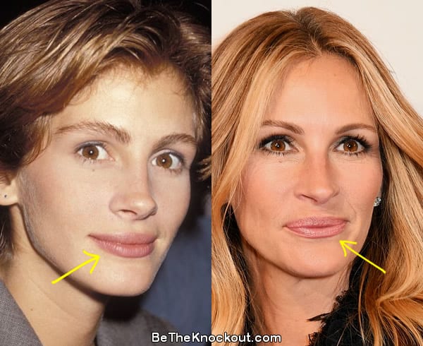 Julia Roberts lip fillers before and after comparison photo