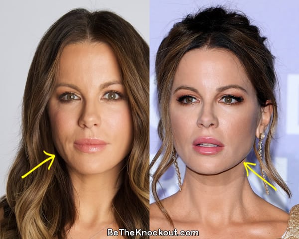 Kate Beckinsale facelift before and after comparison photo