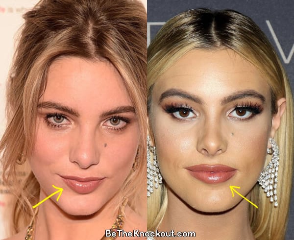Lele Pons lip fillers before and after comparison photo